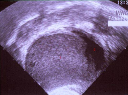 Endometriom, Ultraschall