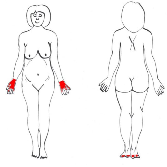 Klassisches Verbreitungsmuster der intrahepatischen Schwangerschaftscholestase