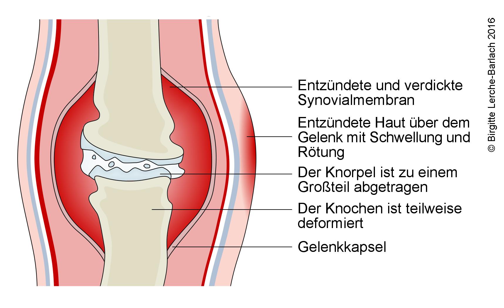 Chronische Arthritis.jpg