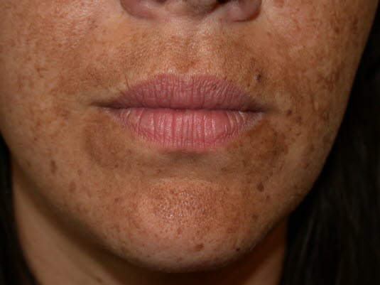 Ein Melasma ist eine symmetrische, fleckige Hyperpigmentierung der Haut, die während der Schwangerschaft oder bei Einnahme von oralen Kontrazeptiva im Gesicht auftreten kann.