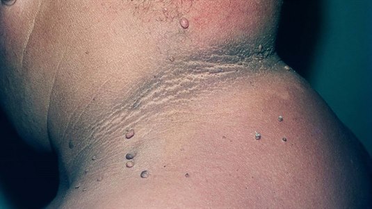 Die Acanthosis nigricans kann in Form eines verdickten, samtigen, braunen Streifens oder einer lederartigen, warzenähnlichen, papillomatösen Läsion in Erscheinung treten. Sie steht häufig mit einer Insulinresistenz oder Übergewicht in Zusammenhang.