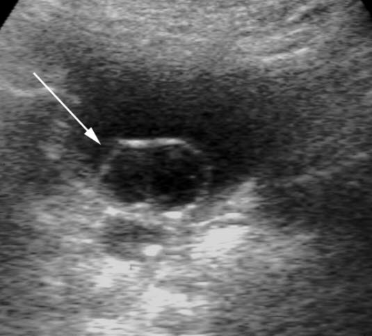 Ureterozele (Ultraschall)