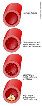 146-arteriosklerose-entwicklung.jpg