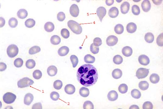 Makrozytäre Anämie mit hypersegmentiertem Granulozyten im Blutausstrich (100-fache Vergrößerung)