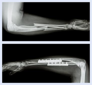 Prä- und postoperatives Röntgen einer osteosynthetisch versorgten Unterarmfraktur