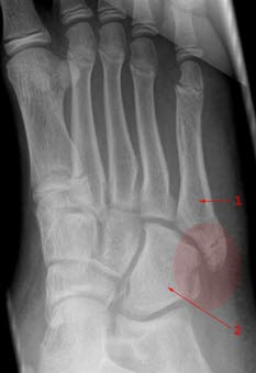 Fraktur ohne Fehlstellung durch die Basis des 5. Metatarsalknochens (1) und lateral im Os cuboideum (2)
