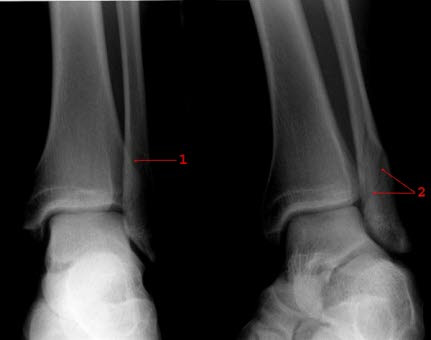 Malleolarfraktur: Aufnahme von vorn und Schrägaufnahme des linken Sprunggelenks: Schrägfraktur (1 und 2) durch den Außenknöchel ohne Fehlstellung; Fraktur in der Schrägaufnahme am besten sichtbar (2)