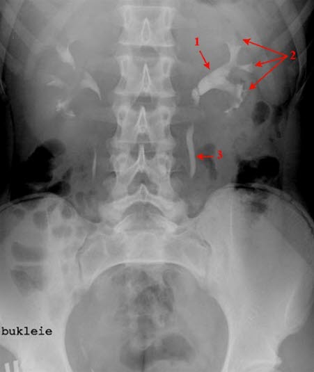 Urografie, Abdomenübersichtsaufnahme. Zeichen eines Harnstaus links: verzögerte Kontrastmittelausscheidung, erweitertes Nierenbecken (1) und dilatierte, plumpe Nierenkelche (2). Harnleiter (3)  