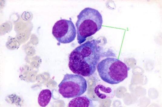 Blutausstrich bei Multiplem Myelom mit Geldrollen(Rouleaux)-Formation von Erythrozyten. 1 = Plasmazellen. 