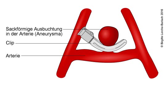 Clipping eines Aneurysmas der A. communicans anterior