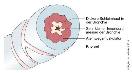 Bronchie bei Asthma