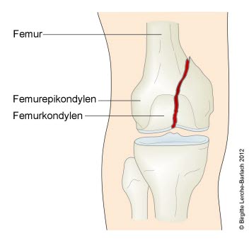Femurfraktur, perkondylär