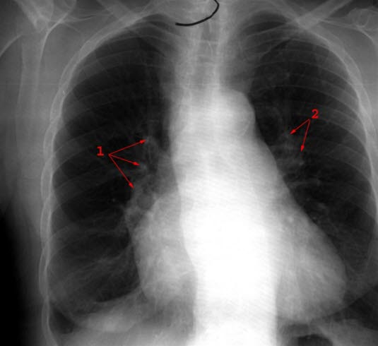 Cor pulmonale - frontal