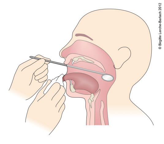 Spiegeluntersuchung des unteren Rachens