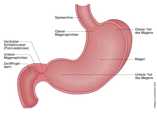 Magen mit Pylorusstenose