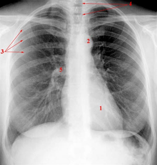 Normales Röntgen des Thorax