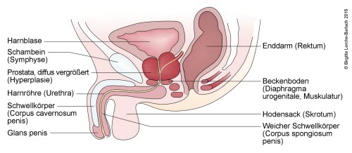 Prostata, vergrößert (Hypertrophie)