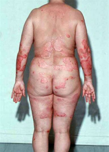 Psoriasis, schwere Form. Bei der Psoriasis liegen neben dem Juckreiz (84 %) und dem Ausschlag in der Regel keine weiteren Symptome vor.