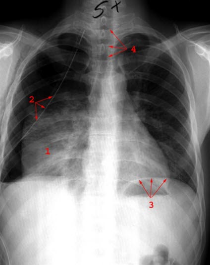 Lobärpneumonie rechts, Röntgen