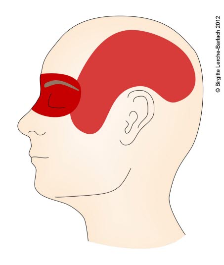 Cluster-Kopfschmerz: Ausbreitung, Seitenansicht