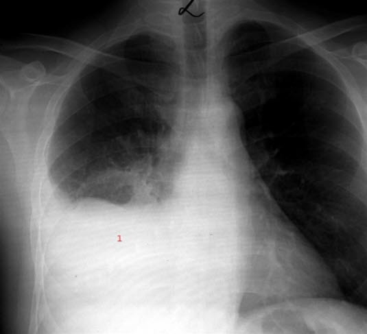 Pleuropneumonie rechts, vorne, Röntgen