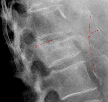 Wirbelsäulenfraktur, Seitenansicht: 1.Kompressionsfraktur, 2. Wandverkalkungen in der Aorta (Nebenbefund)