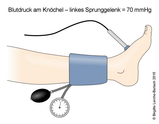 Blutdruck am Fußgelenk