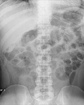 Röntgen: Dünndarmobstruktion mit dilatierten Darmschlingen
