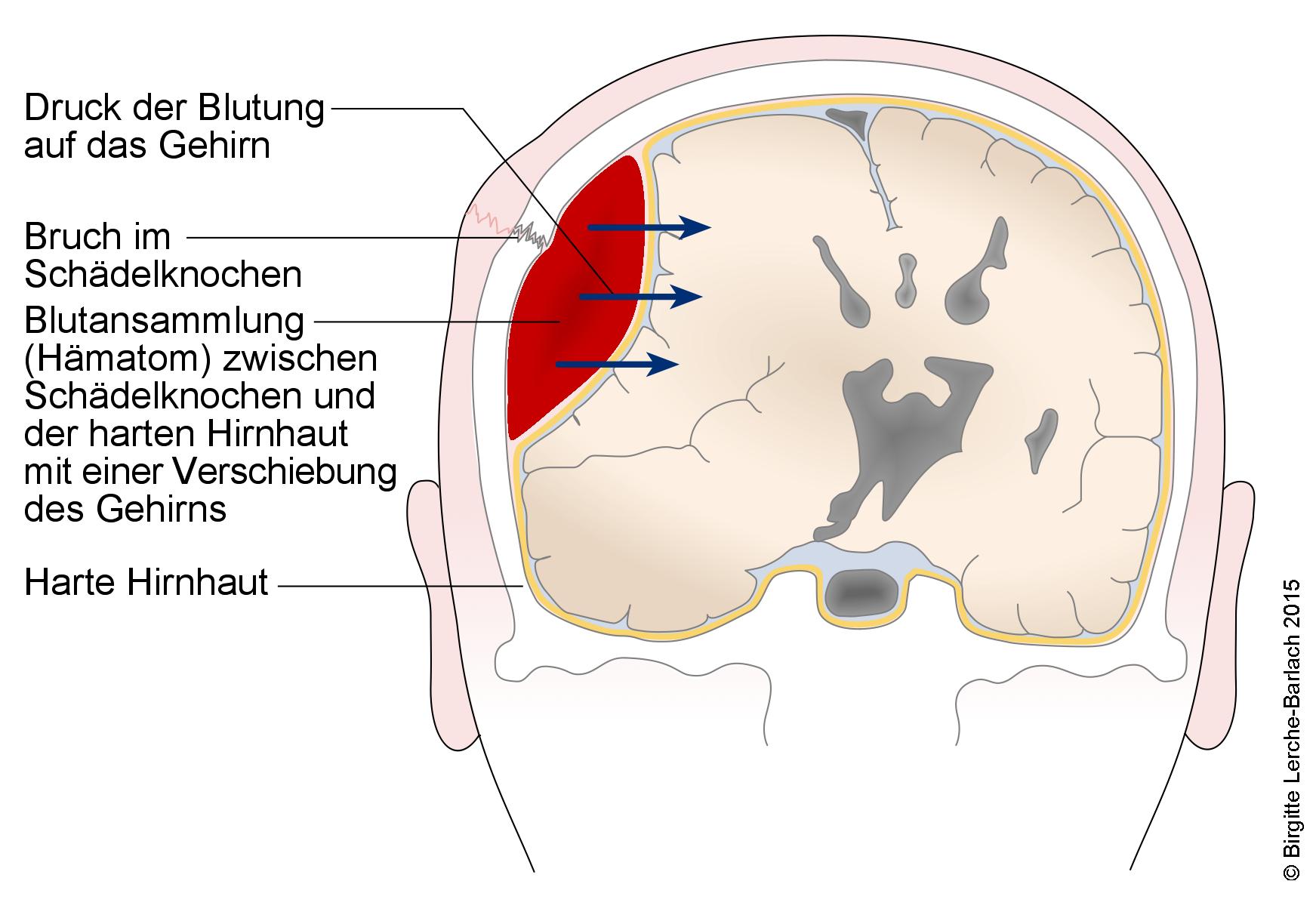 Epidurales Hämatom