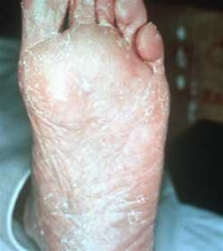 Fußpilz (Tinea pedis) - Deximed