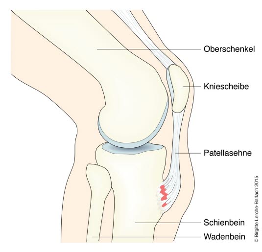 M. Osgood-Schlatter