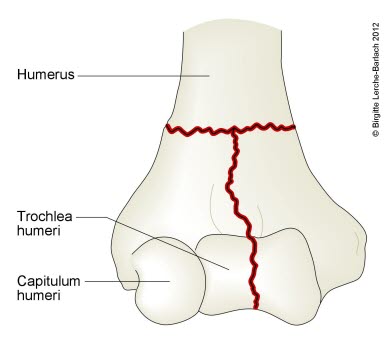 Humerusfraktur, (T-Fraktur) transkondylär