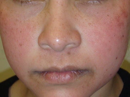 Ringelröteln (Erythema infectiosum)