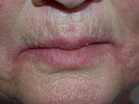 Kandidose der Lippen