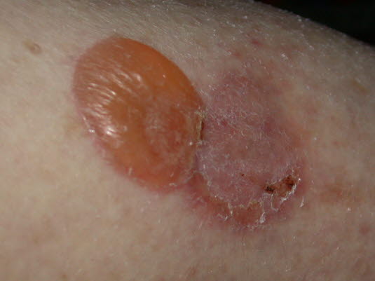 Bullöses Pemphigoid