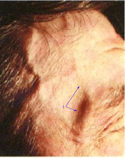 Arteriitis temporalis