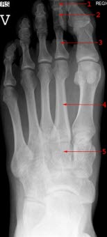 A.-p.-Aufnahme eines normalen Fußes: (1) Distale Phalanx, (2) Phalanx media, (3) proximale Phalanx, (4) Os metatarsale II, (5) Os cuneiforme intermedium (mittleres Keilbein).