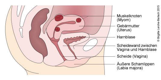 Myome im Uterus