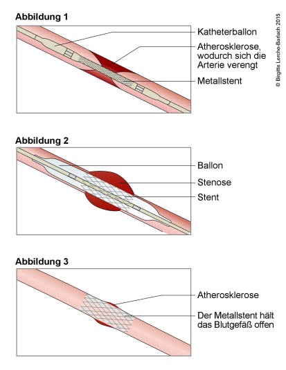  Stentbehandlung eines engen Blutgefäßes