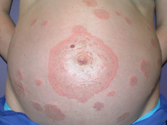 Schwangerschafts-Pemphigoid