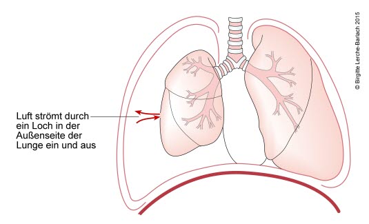 Pneumothorax, total