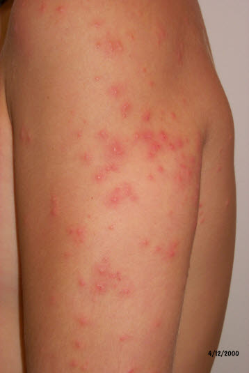 Badedermatitis (Zerkariendermatitis)