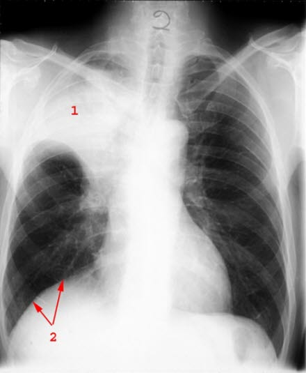 Atelektase durch einen Tumor