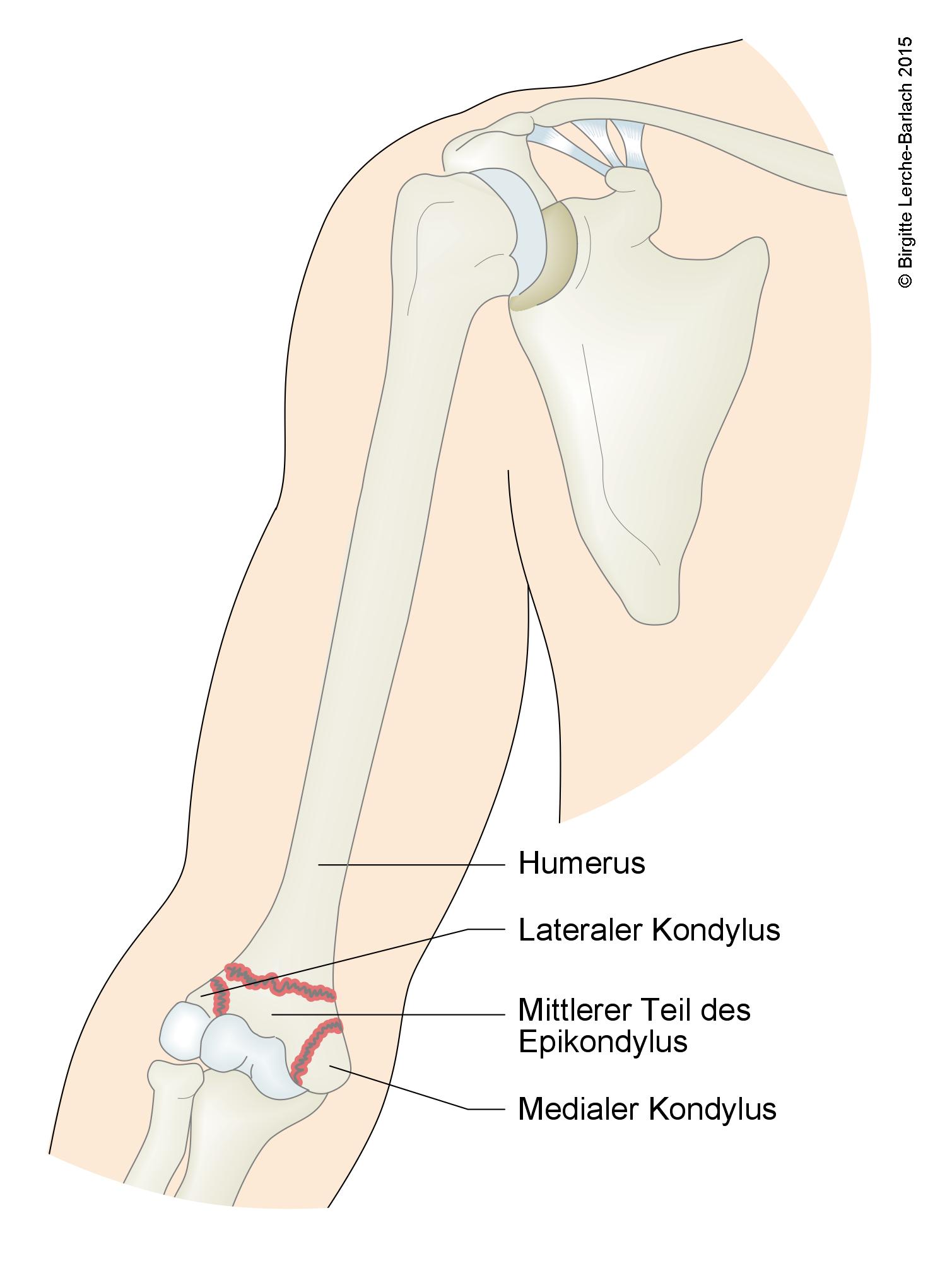 Humerus, transkondyläre Fraktur