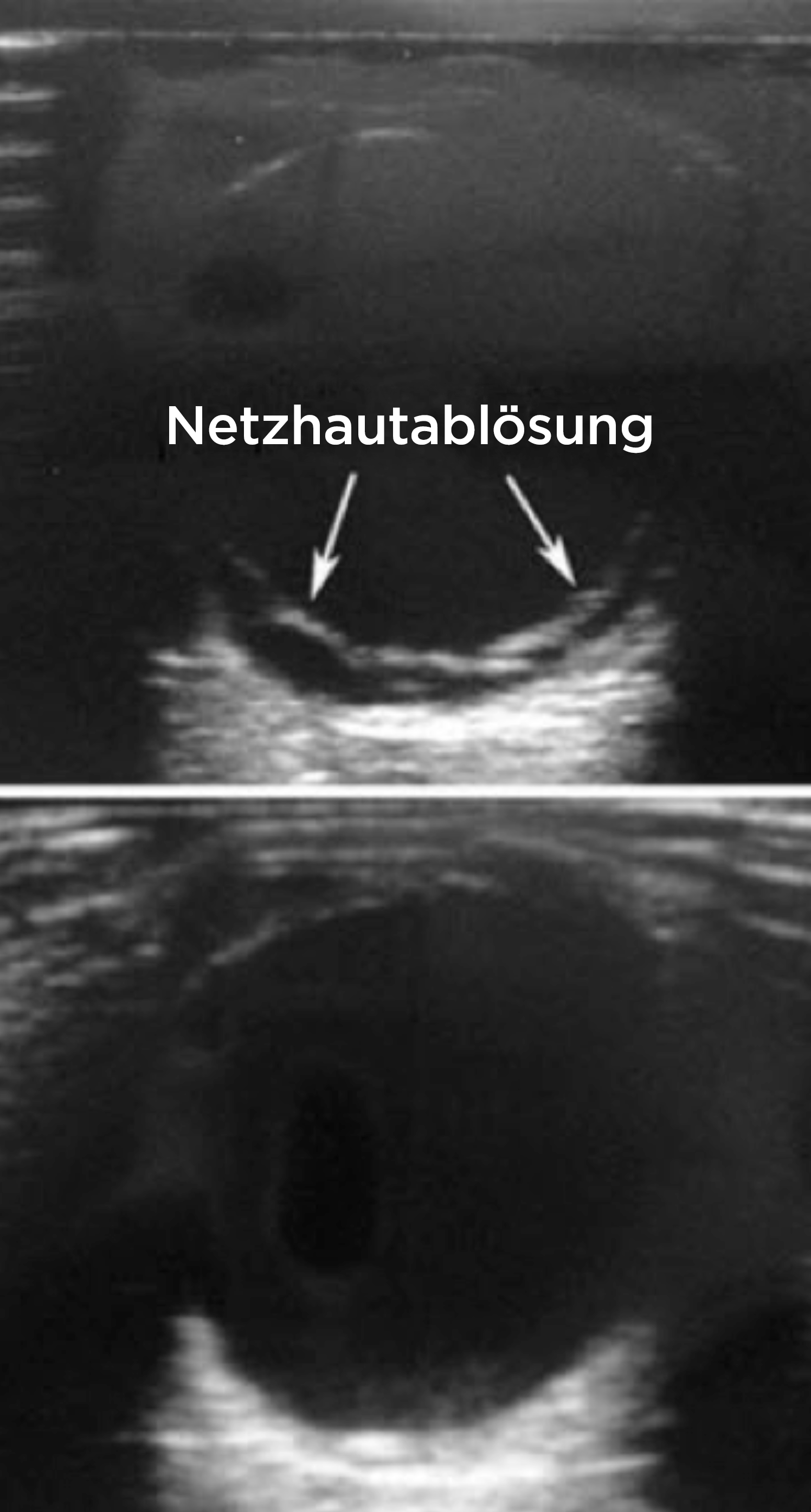 Netzhautablösung, Ultraschall