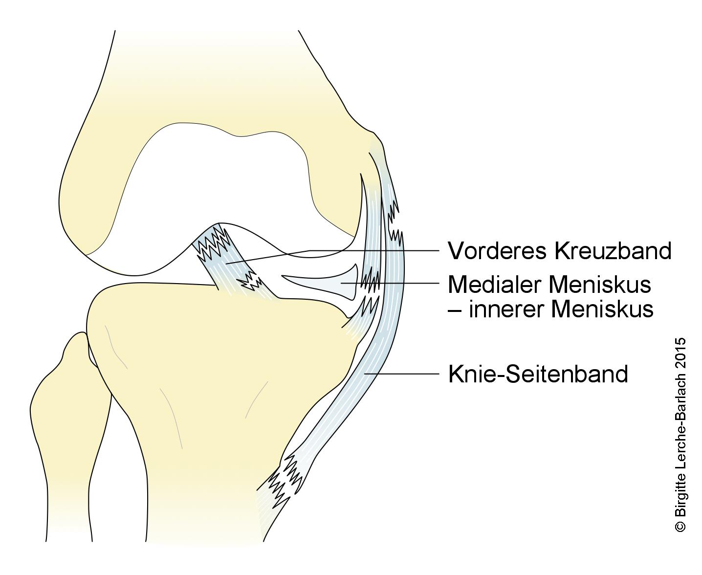 Knie: Läsion an Bändern, Kreuzband und Meniskus