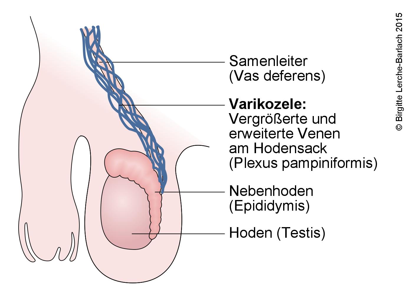 Skrotum - Varikozele