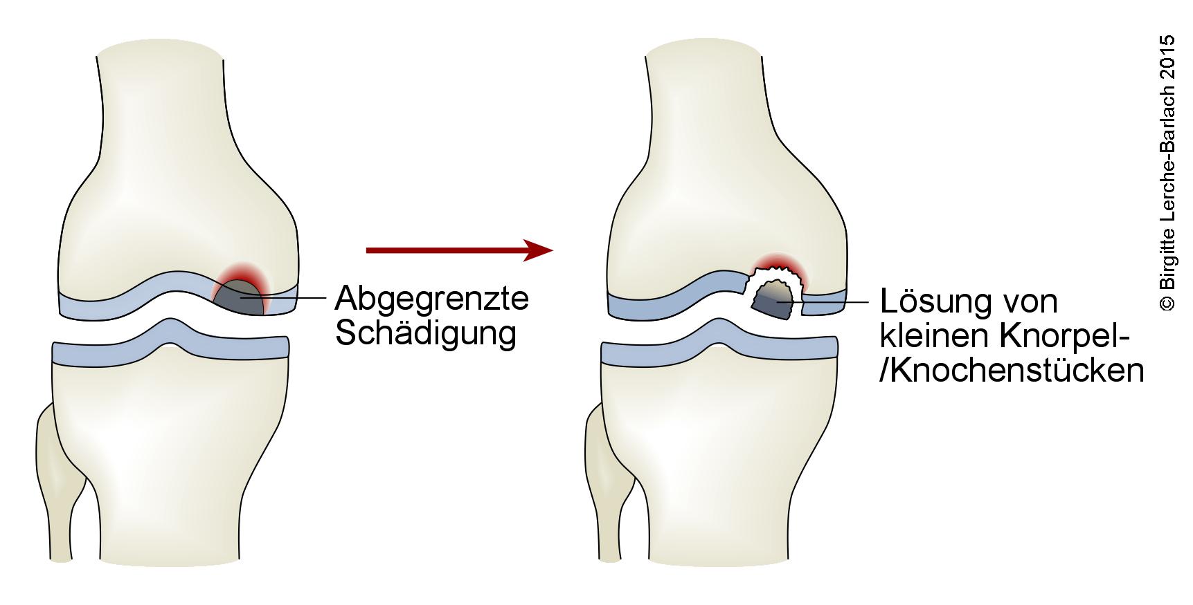 Osteochondritis (geloestes Fragment im Knie).jpg