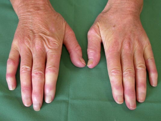 Raynaud-Syndrom