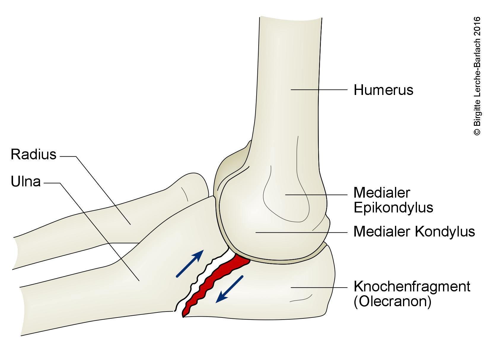 Ulnafraktur, schiefer Bruch